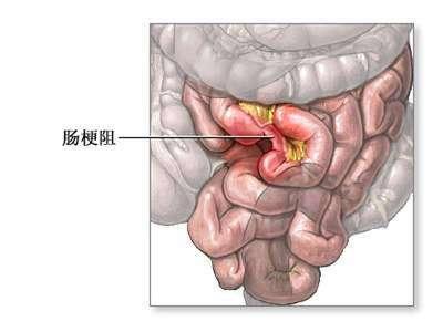 适用于单纯性粘连性肠梗阻,麻痹性或痉挛性肠梗阻,蛔虫性或粪块堵塞