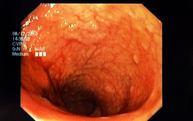 恰玛古素食粉是“养胃之王”，每天冲水喝点，缓解胃病
