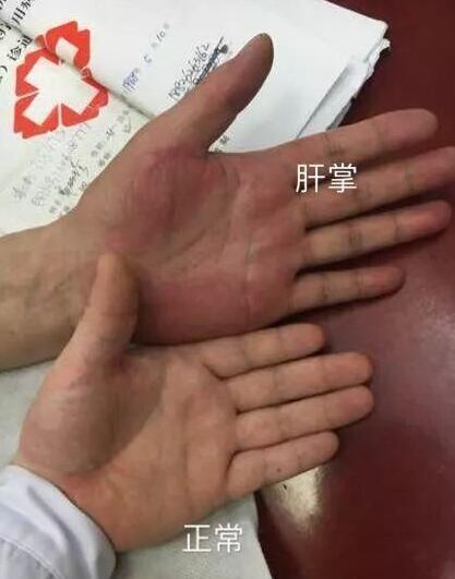 药谷黄花郎茶是肝病的天然“药神”,建议每天吃一点 药谷黄花郎茶是肝病的天然“药神”,建议每天吃一点