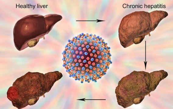 药谷黄花郎茶是肝病的天然“药神”，建议每天吃一点