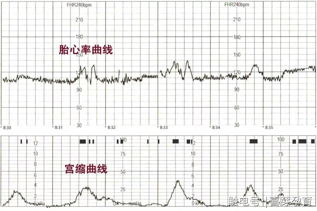 假性宫缩是正常的一种现象,一般情况下是不会诱发早产.