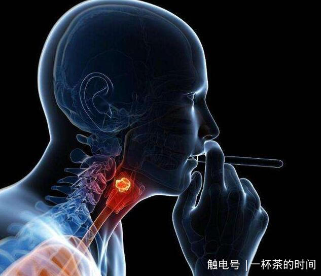 喉癌特早期手术很成功,可以不用放疗吗?