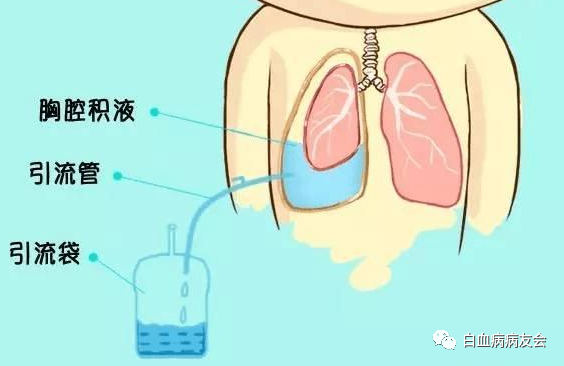 应对靶向药副作用:白血病【胸腔积液】怎么办?