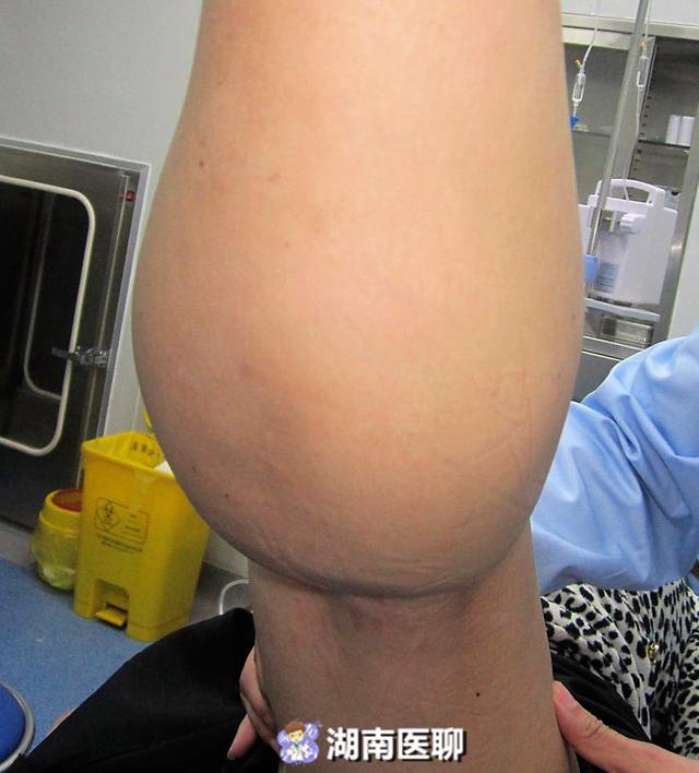 大腿动脉瘤图片图片