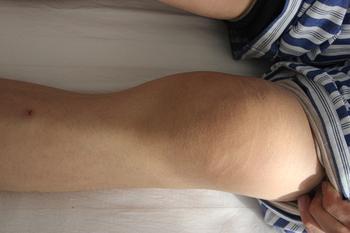 血友病患者发生口,鼻出血怎么办?